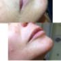 Sugaring