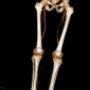 CT Beckenbein Angiographie