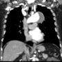 CT Angiographie Aortenaneurysma