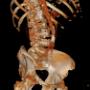 CT Angiographie der Aorta