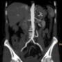 CT Angio Aorta abdominalis