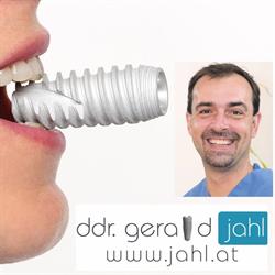 DDr. Gerald Jahl / Implantat im Zentrum- Allon4