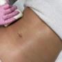 T- Shape Bauch Behandlung